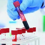 Blood test can predict lung cancer 5 years before diagnosis