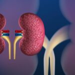 Nearly half of 844 million chronic kidney disease cases remain undiagnosed worldwide: Lancet