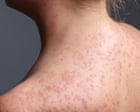 California warns of measles exposure in six counties from unvaccinated train passenger